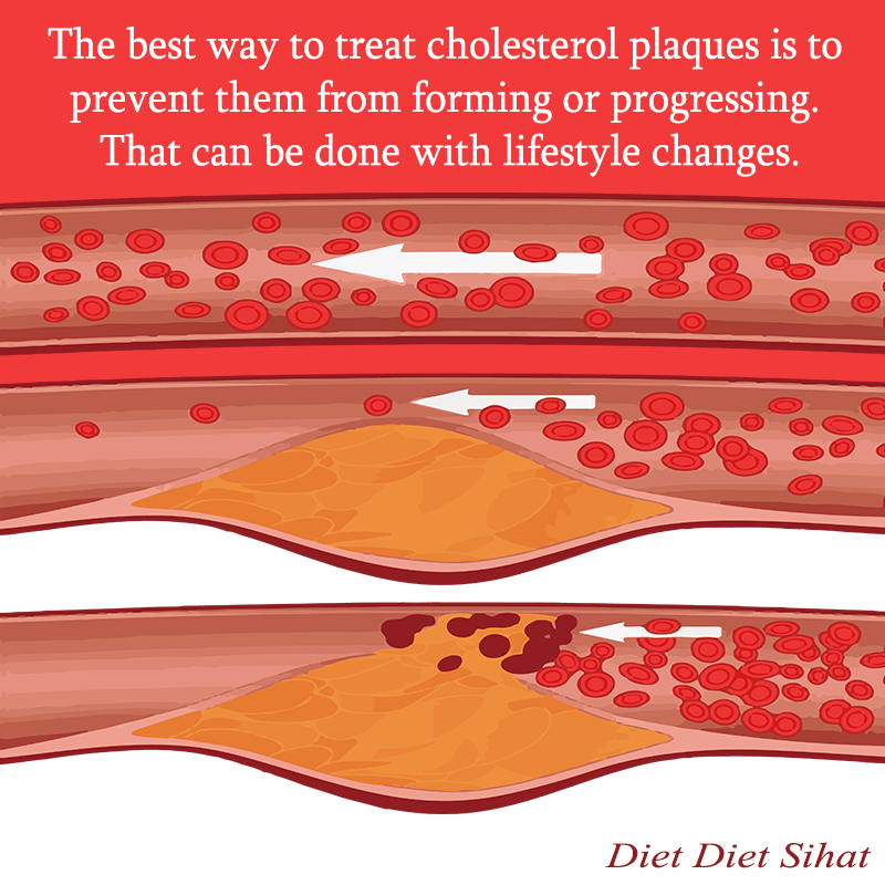 Kolesterol: 5 Makanan Yang Mampu Rendahkan Kadar Kolesterol