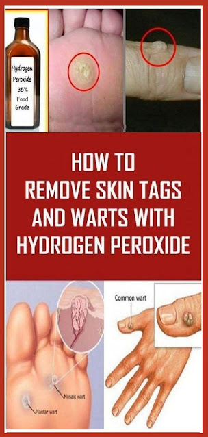How to Easily Remove Warts And Skin Tags With Hydrogen Peroxide