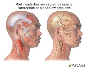 Tension Headache atau Tension Type Headache (TTH)