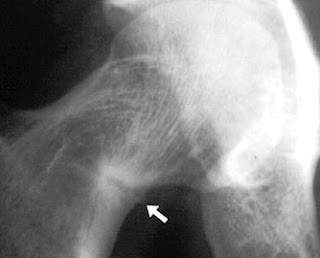 pseudofractura col femural