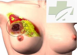 cara pengobatan kanker payudara menggunakan daun sirsak, pengobatan kanker payudara dengan kulit manggis, apakah propolis bisa menyembuhkan kanker payudara, tanaman yang dapat menyembuhkan kanker payudara, obat herbal pasca operasi kanker payudara, forum obat tradisional kanker payudara, tanda2 gejala awal kanker payudara, perbedaan kanker payudara pada pria dan wanita, kanker payudara karena rokok, kanker payudara yang menyebar ke tulang, obat kimia kanker payudara, obat herbal untuk menyembuhkan penyakit kanker payudara, harga obat kanker payudara, kanker payudara untuk pria, herbal kanker payudara, adakah kanker payudara pada pria, cara menyembuhkan kanker payudara secara alami, pengobatan alternatif kanker payudara di bandung, obat kangker payudara apa, obat herbal untuk gejala kanker payudara, kanker payudara menurut who tahun 2011, tumbuhan herbal obat kanker payudara, jenis kanker payudara pada pria dan wanita, kanker payudara metastase, kanker payudara ibu hamil, cara mengobati kanker payudara dengan alami, kanker payudara pada ibu menyusui