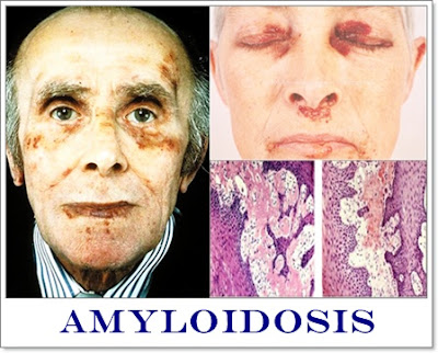 Obat Amyloidosis Herbal