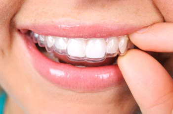 Ưu - nhược điểm niềng răng Invisalign