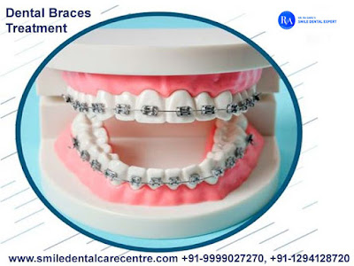 Dental Braces Treatment in India