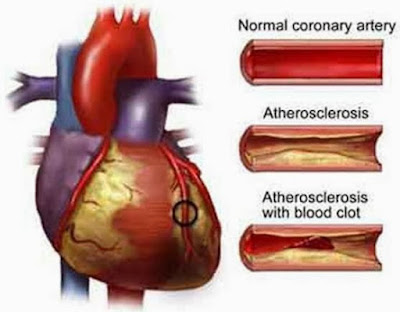 Pengertian Penyakit Infark Miokard Akut Pada Jantung