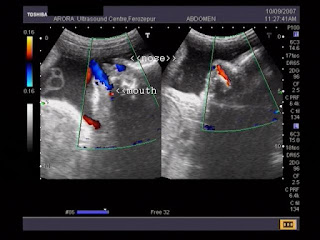 color doppler image