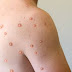 Monkey Pox-What US Declares about Monkey pox?