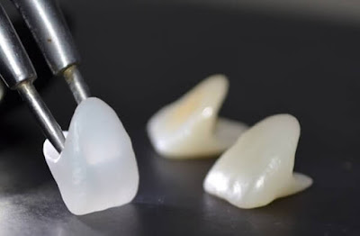 Quy trình bọc răng sứ cho răng khểnh