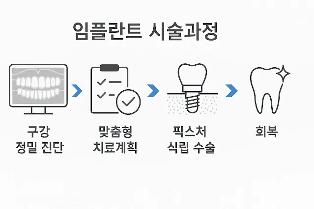 임플란트 시술과정 4단계 순서도 – 구강 정밀 진단, 맞춤형 치료계획, 픽스처 식립 수술, 회복 과정 인포그래픽