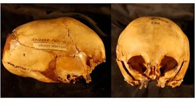 Ancient Aliens skull cranial deformation.