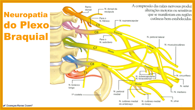Neuropatia do Plexo Braquial