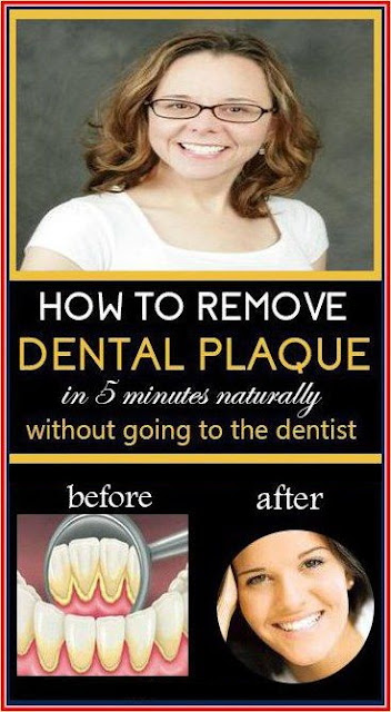 How To Remove Dental Plaque In 5 Minutes Naturally, Without Going To The Dentist!!!