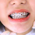 Niềng răng mắc cài kim loại có tốt không?