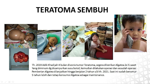 Pengobatan kanker teratoma