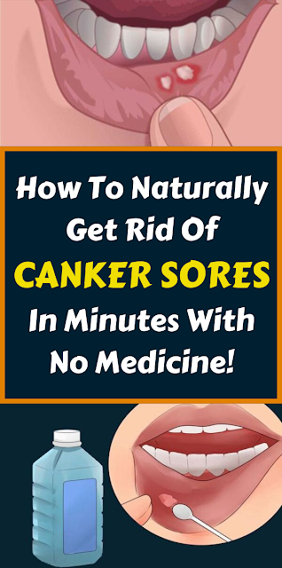 How to cure canker sores and mouth sores?