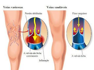 Síndrome dos Ovários Policísticos