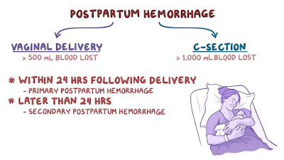 Postpartum Hemmorrhage defined - infographic