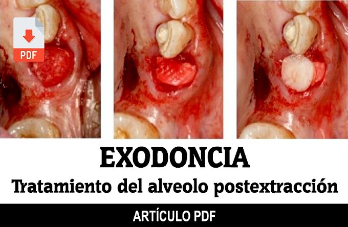 EXODONCIA: Tratamiento del alveolo postextracción. Revisión de la literatura actual a propósito de un caso clínico