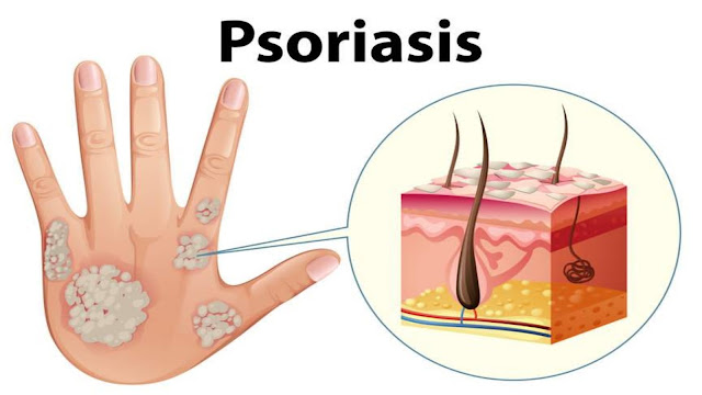 https://www.healthandfitnessexpert.in/2024/04/psoriasis-symptoms-couses-and-treatment.html