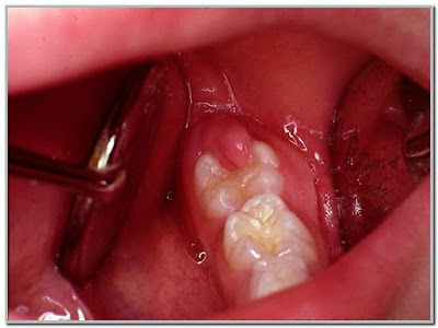 Cung cấp bảng chi phí điều trị áp xe răng tại nha khoa 1