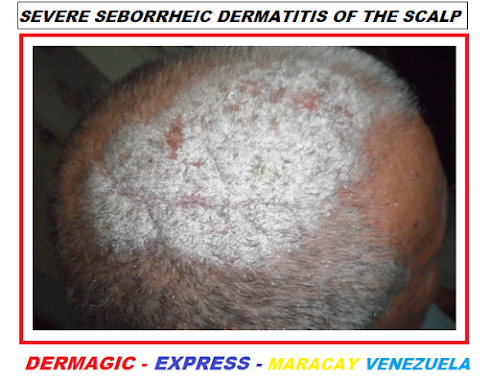 Dermatitis seborreica cuero cabelludo