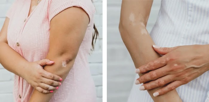 What is the best treatment for vitiligo? Treatment & Recovery