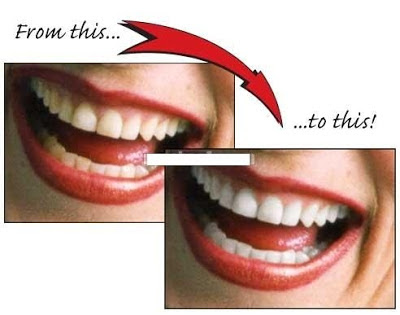Các cách làm trắng răng tại nha khoa hiện nay