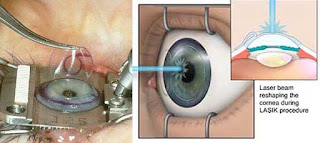 laser eye surgery Kuwait