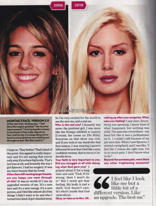 heidi montag surgery. heidi montag before and after