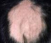 Alopecia areata