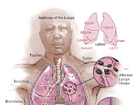 폐암의 중의치료