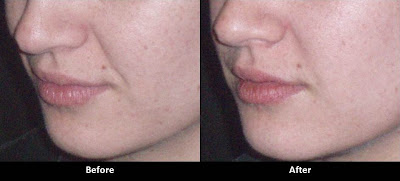 Juvederm for Jowls Before and After