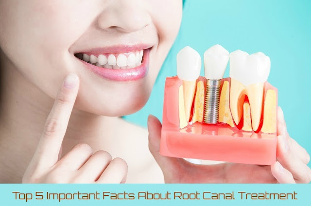 Top 5 Important Facts About Root Canal Treatment