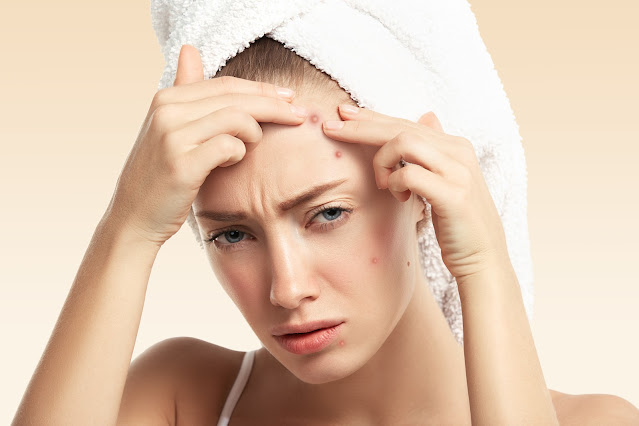 pimples kaise hataye