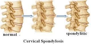 Cervical Spondylosis bone spurs