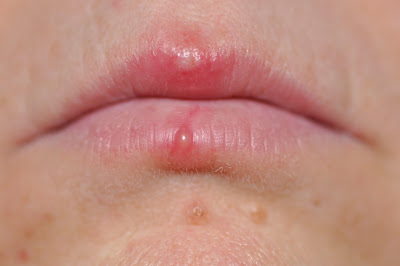 Lip Sore Natural Treatment : Teach Your Kids How To Avoid Catching Cold Sores