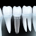 Cấy ghép răng implant ở đâu tốt nhất hiện nay?