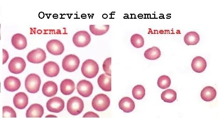 Overview of anemias