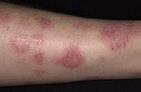 Eczema dan Alahan Kulit : Legakan dgn GLA Complex dan ESP 