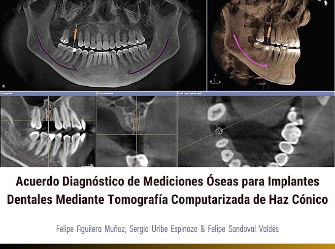 PDF: Acuerdo Diagnóstico de Mediciones Óseas para Implantes Dentales Mediante Tomografía Computarizada de Haz Cónico