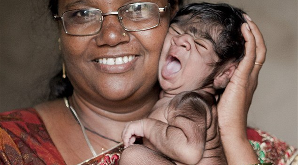 بالصور .. ولادة طفلة مستئذبة ومغطاة بالشعر في الهند