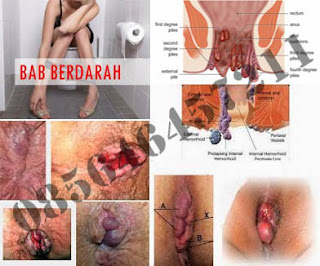 Obat Wasir (Hemoroid) Ambejoss Wikipedia