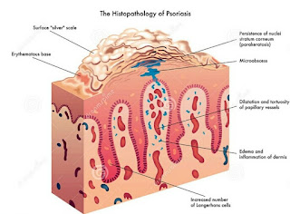 HISTOPATHOLOGY of psoriasis
