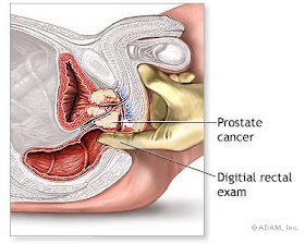 How to prevent prostrate cancer