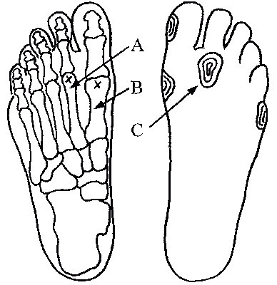 Mtp Joint Foot. 1st MTP (metatarsal