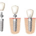 Trồng răng Implant là gì?