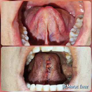 Ankyloglossia,Diagnosis of Tongue Tie,Treatment of Tongue Tie,Tongue tie surgery,Frenulectomy,Post-Operative Instructions for Tongue Tie Surgery,Symptoms of Tongue Tie,tongue tie,Frenectomy,