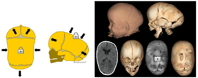 Esquema e imágenes de la Escafocefalia, consistente en el cierre precoz de la sutura sagital.