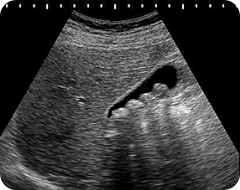 gall stone in ultrasound