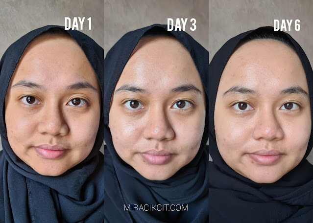 Results Using FOREO UFO Before & After